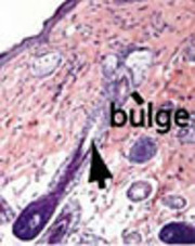 脱毛症治療の鍵が傷の治癒に